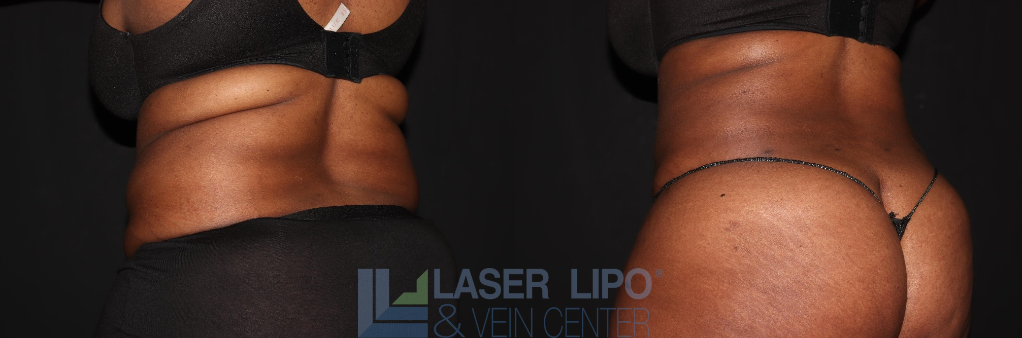 Before and After Image: Liposuction – Back - left-back-oblique